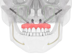 お値下げ相談可能！MAXILLA-ORIENTED IMPLANTOLOGY Zygomatic implants: A paradigm shift in the treatment of